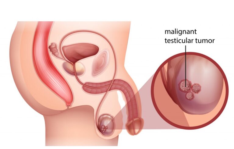 testicular-cancer-treatment-1024x652