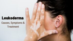 Leukoderma-Causes-Symptoms-Treatment
